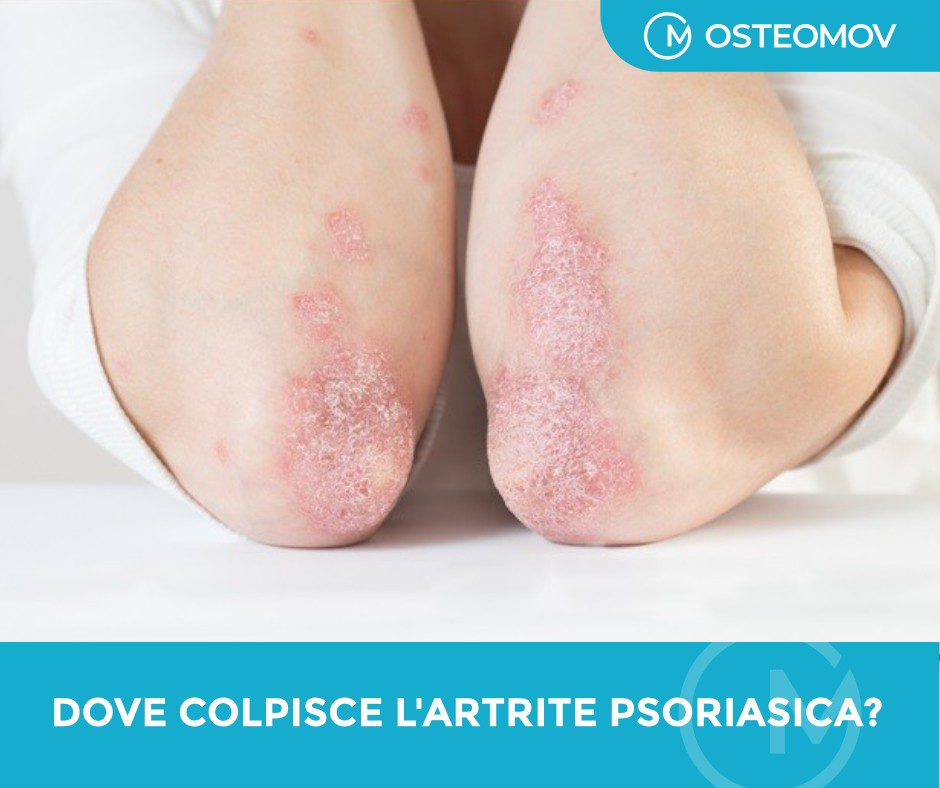Artrite psoriasica