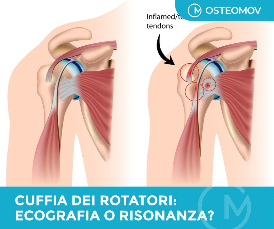 sindrome cuffia rotatori