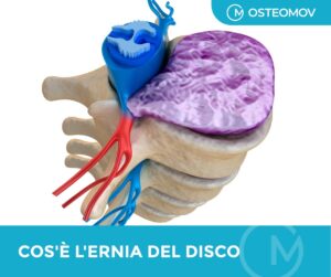 ernia del disco lombare