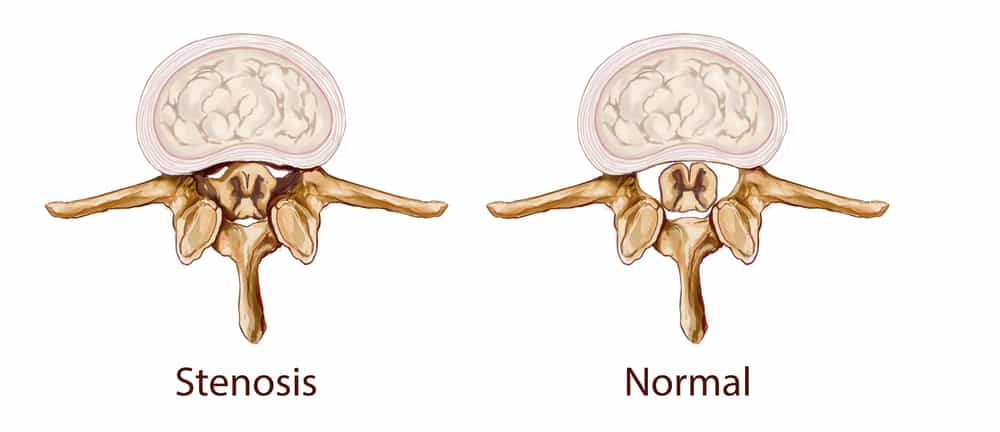 cosa sono le stenosi spinali